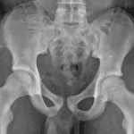 Red arrow: ASIS avulsion fracture in this patient.
