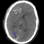 Blue arrow: thin acute subdural hematoma along the right aspect of the posterior falx.