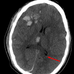 Red arrow: small amount of intraventricular hemorrhage layering in the occipital horn of the left lateral ventricle.