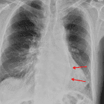 Red arrows: left lower lobe collapse with medial displacement of the collapsed lobe.