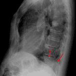 Red arrows: collapsed left lower lobe overlying the posterior left hemidiaphragm.
