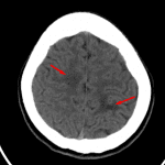 Red arrows: abnormal hypodensity within the subcortical white matter of the right frontal and high left parietal lobes