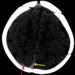 Thin acute subdural hematoma layering along the posterior right parietal lobe (red arrow) and posterior interhemispheric falx (yellow arrow).