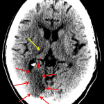 Red arrows: acute/early subacute infarct in the right occipital lobe. Yellow arrow: age-indeterminate right thalamic infarct (looked acute on the subsequent MRI)
