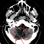 PICA Territory Infarcts - Red arrows: right greater than left medial cerebellar infarcts in the PICA distribution