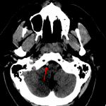 PICA Territory Infarcts - Red arrow: asymmetric high density in the intradural right vertebral artery worrisome for thrombus