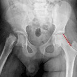 Displaced right Slipped capital femoral epiphysis (SCFE). Normal appearance of the left femoral head with Klein's line (red line) intersecting the left femoral head.