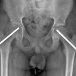 Followup radiograph in this patient after bilateral hip pinning.