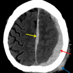 Red arrow: acute subdural hematoma layering along the left cerebral convexity. Yellow arrow: subdural hematoma layering along the interhemispheric falx. Blue arrow: scalp hematoma.