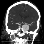 Subsequent CTA confirms a large aneurysm arising from the left cavernous carotid artery.