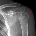 Red arrow: Hill-Sachs lesion on this patient's postreduction radiographs.