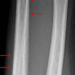 Followup radiographs obtained one month later in this patient show subtle periosteal reaction around the ulna (red arrows) indicating healing changes from bowing fractures.