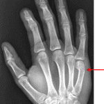 Red arrow: Boxer's fracture of the fifth metacarpal neck.