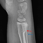 Acute buckle fractures of the dorsal distal radial (red arrow) and ulnar (blue arrow) metaphyses.