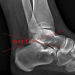 Normal lateral ankle radiograph with Bohler's angle measuring greater than 20 degrees.