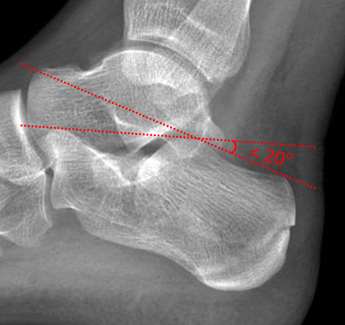 Calcaneal Fracture Angle