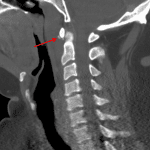 Red arrow: amorphous calcification in the longus colli muscle/tendon.