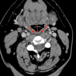 Red arrows: mild prevertebral edema.