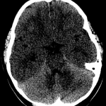 Look at the difference in attenuation of cerebellar gray matter (posterior) and cerebral gray matter (anterior) in this case of diffuse cerebral edema.