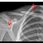 Red arrows: upward pull on the medial fracture fragment by the SCM and downward pull on the lateral fragment by the weight of the arm. Blue line: normal coracoclavicular distance
