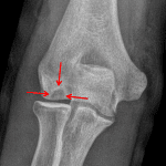 Red arrows: Osteochondral defect of the capitellum.