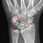 Greater (red line) and lesser (green line) carpal arcs. This is a normal wrist radiograph from a different patient.