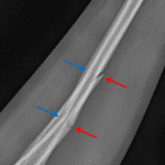 Greenstick Fracture - Red arrows: disrupted cortex. Blue arrows: intact opposite cortex.