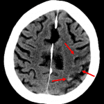 Red arrows: cortical-based gyriform areas of high density along the superior aspect of this patient's left MCA infarct.
