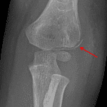 Red arrow: lateral condyle fracture.