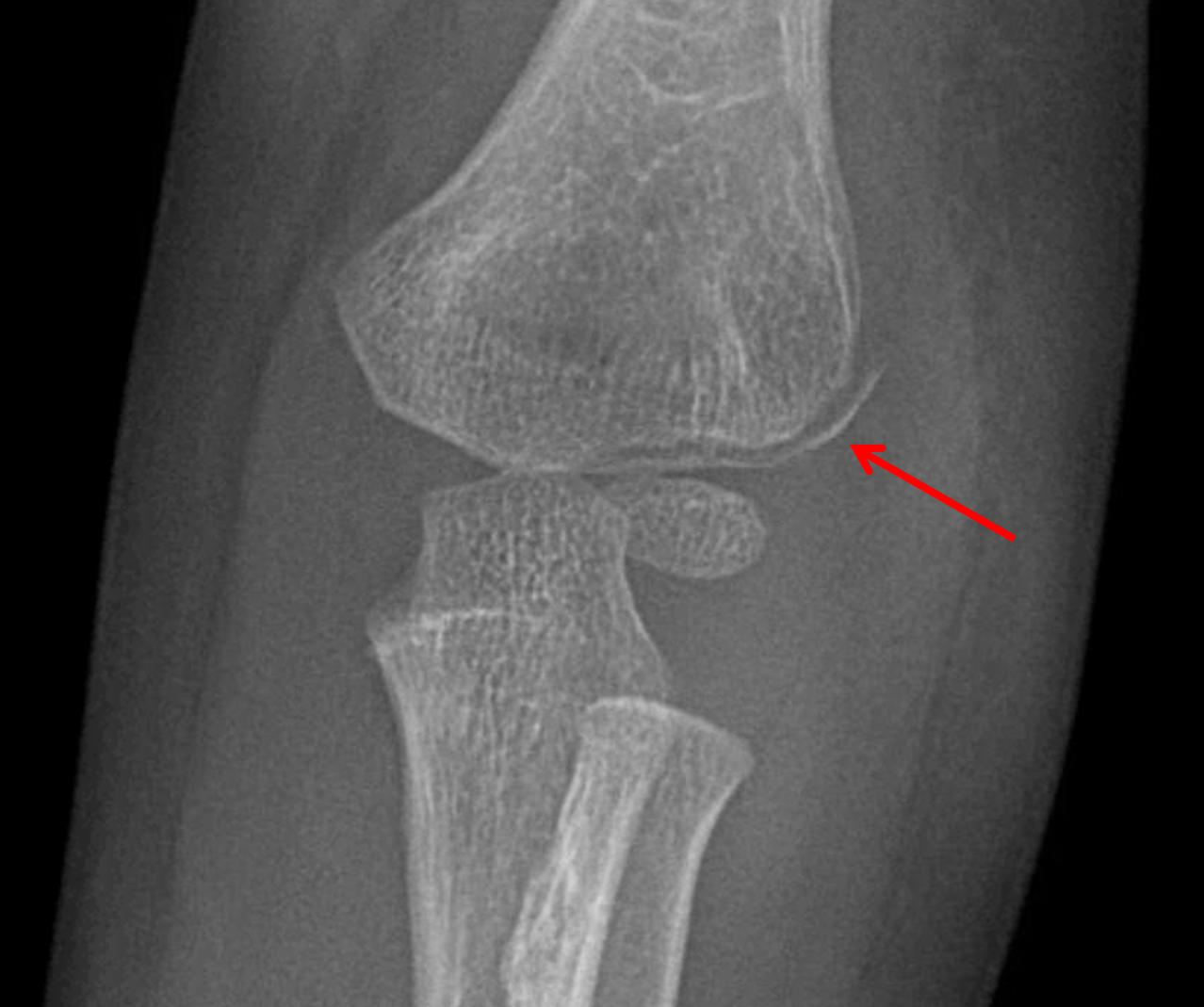 Femoral Condyle Insufficiency Fracture