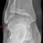 Red arrow: lateral talar process avulsion fracture.