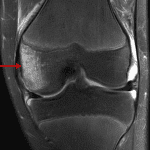 Followup knee MRI in this patient shows a large medial femoral condyle bone contusion without clear fracture line.