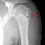 Red arrow: widening and irregularity of the proximal left humeral physis consistent with Little League Shoulder injury