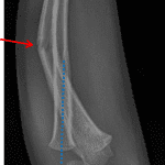 Red arrow: ulnar fracture. Blue dotted line: offset of the radiocapitellar line indicating proximal radial dislocation.