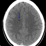 Blue arrow: additional small hypodensity in the right periventricular white matter