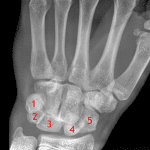 Too many bones in the proximal carpal row: 1- pisiform, 2- triquetrum, 3- lunate, 4+5- scaphoid fracture fragments.