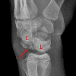 Lateral view shows dorsal dislocation of the capitate (C) along with the distal carpal row with the lunate (L) still positioned in the lunate fossa of the radius. A small bone fragment is noted along the posterior margin of the lunate (red arrow).
