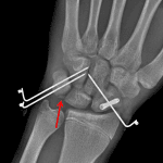 Postoperative radiographs for this patient show percutaneous pins transfixing the greater carpal arc and a headless scaphoid screw. A fracture fragment adjacent to the triquetrum likely correlates with the fragment along the dorsal margin of the lunate on the prior lateral view.