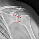 Red arrows: example of a trough sign in an adult patient with posterior shoulder dislocation.
