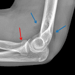 Red arrow: mildly impacted radial head fracture. Blue arrows: uplifted anterior and posterior fat pads indicative of a joint effusion.