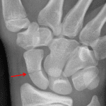 Scaphoid view demonstrating the nondisplaced scaphoid waist fracture (red arrow).