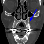 Blue arrow: subtle buccal surface cortical dehiscence associated with the left second maxillary premolar.