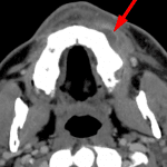 Red arrow: subperiosteal abscess.