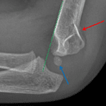 Anterior offset of the anterior humeral line (green dotted line) relative to the capitellum (blue arrow). Acute supracondylar fracture with mild posterior angulation (red arrow).