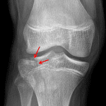 Red arrows: minimally depressed Saltar IV fracture of the lateral tibial plateau (Schatzker I).