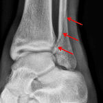 Red arrows: oblique fibular fracture with fracture line exiting at the level of the talar dome medially (Weber type B).