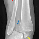 Weber type C fracture - Angulated distal fibular fracture (red arrow) with associated tibiofibular syndesmotic injury and displaced posterior (blue arrow) and medial (yellow arrow) malleolar fractures.
