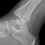 Posterior dislocation of the ankle with the talar dome (red dotted line) positioned posterior to the tibial plafond (blue dotted line).