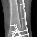 Radiograph in this patient after ORIF.