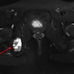 Red arrow: multiple fluid-fluid levels identified on this T2-weighted axial MR image with fat saturation in this patient.